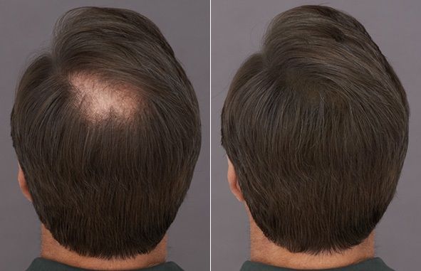 Before and after