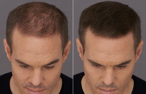 Before and after