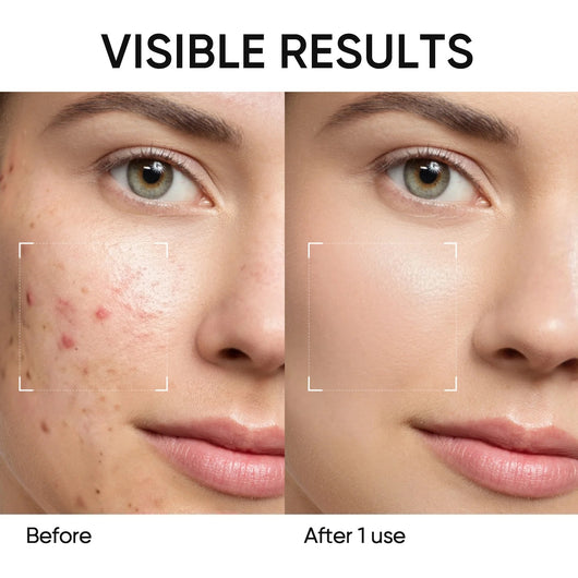 Acne Clay Mask Stick Mugwort Green